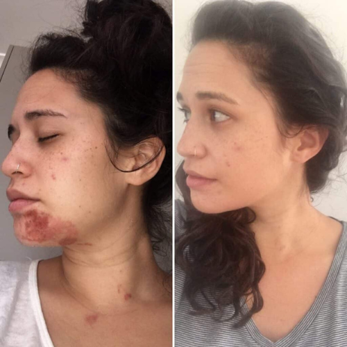 Red Light Therapy Healing